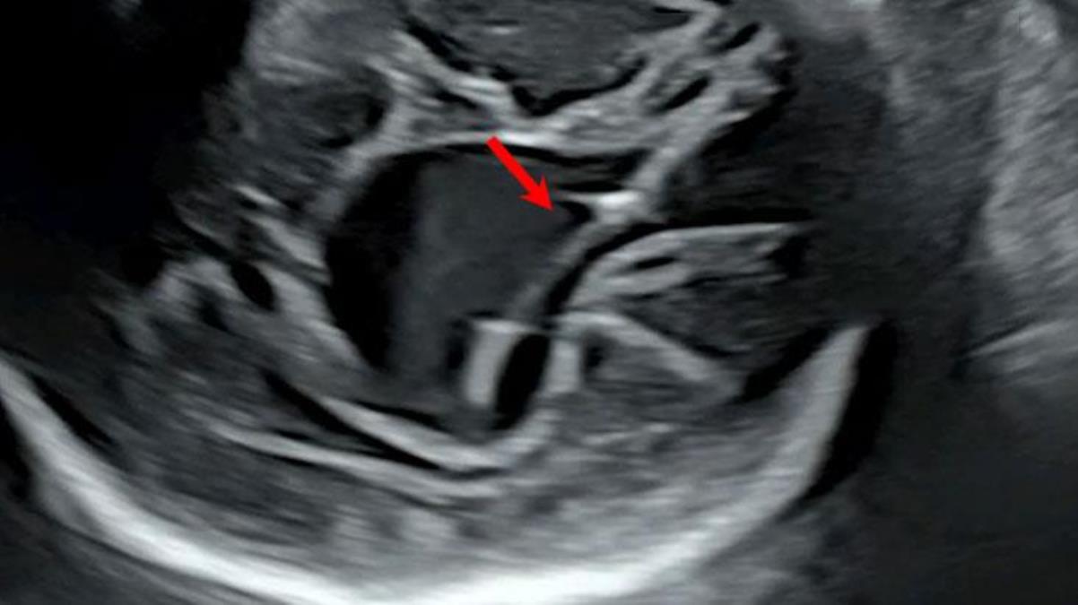 Türünün ilk örneği! ABD’de anne karnındaki bebeğe beyin ameliyatı yapıldı