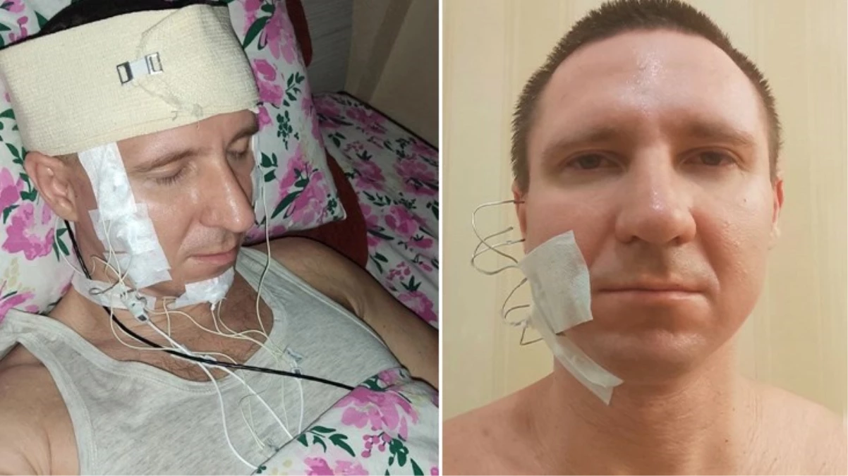 Rusya’da bir adam, rüyalarını kontrol edebilmek için kafasını matkapla deldi