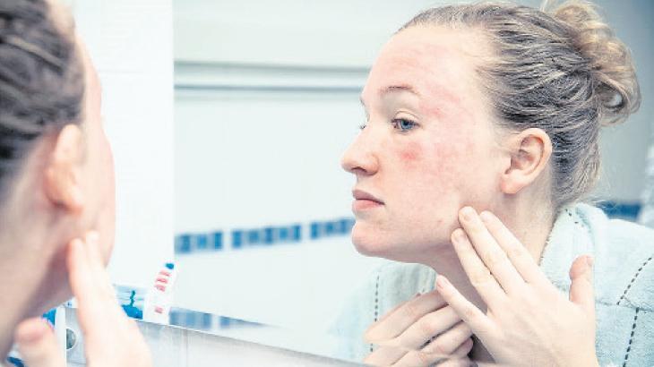 Uyuz, 15 dakikalık temasla bulaşıyor