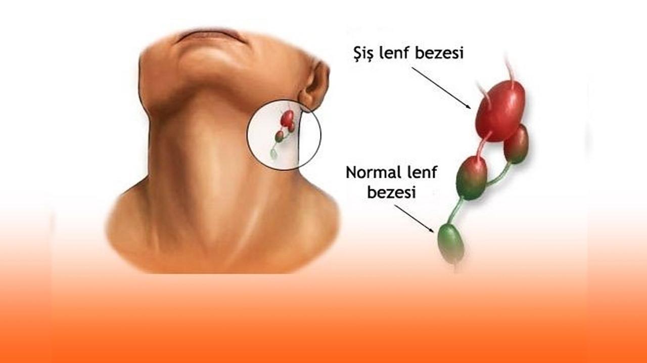 Lenf kanseri nedir, lenfoma kanseri belirtileri nelerdir? Lenf kanseri ölümcül müdür?