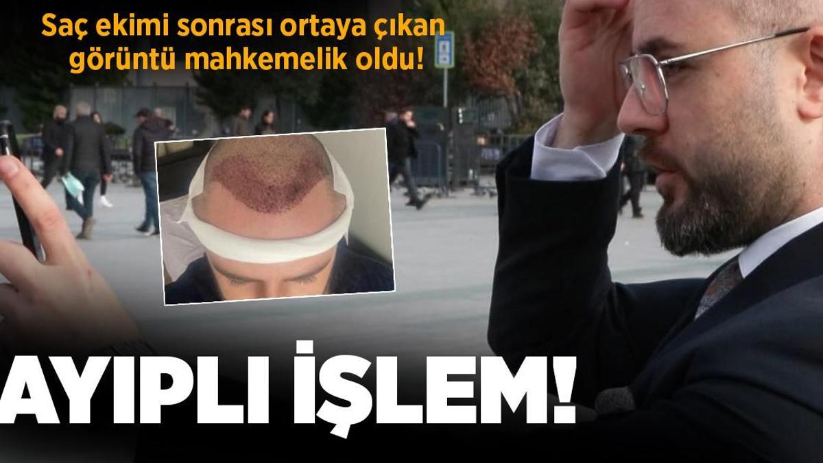 Saç ektirdi hayatı karardı!