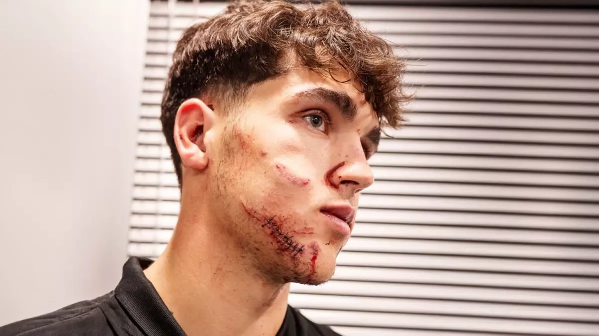 Barcelona’nın yıldızının suratı dağıldı: Tam 10 dikiş atıldı